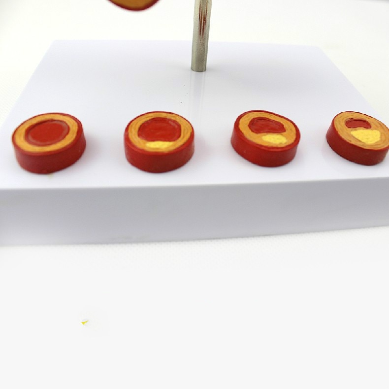 10X Enlarge Human Arterial Coronary Arteriosclerosis Atherosclerosis Coronary Model Cross Section Heart Disease Thrombus Model