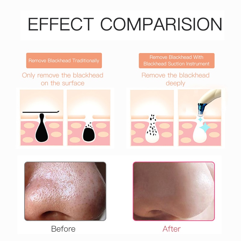 ROSALIND Blackhead Remover Facial Deep Cleaner Skin Care Pore Vacuum Acne Pimple Black Dot Remover Machine Skin Care Tools