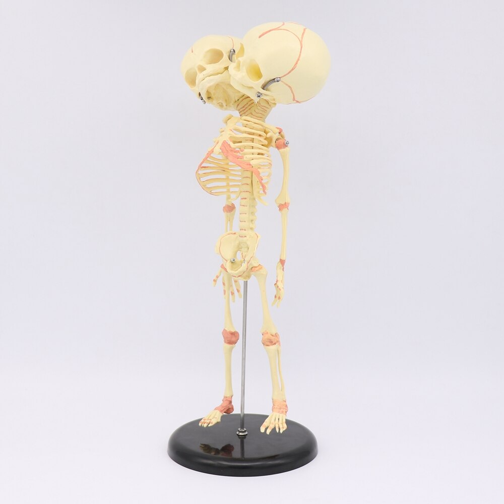 35CM crâne à deux têtes humain -né bébé Double tête anatomie crâne squelette anatomique éducation cérébrale modèle d'étude anatomique