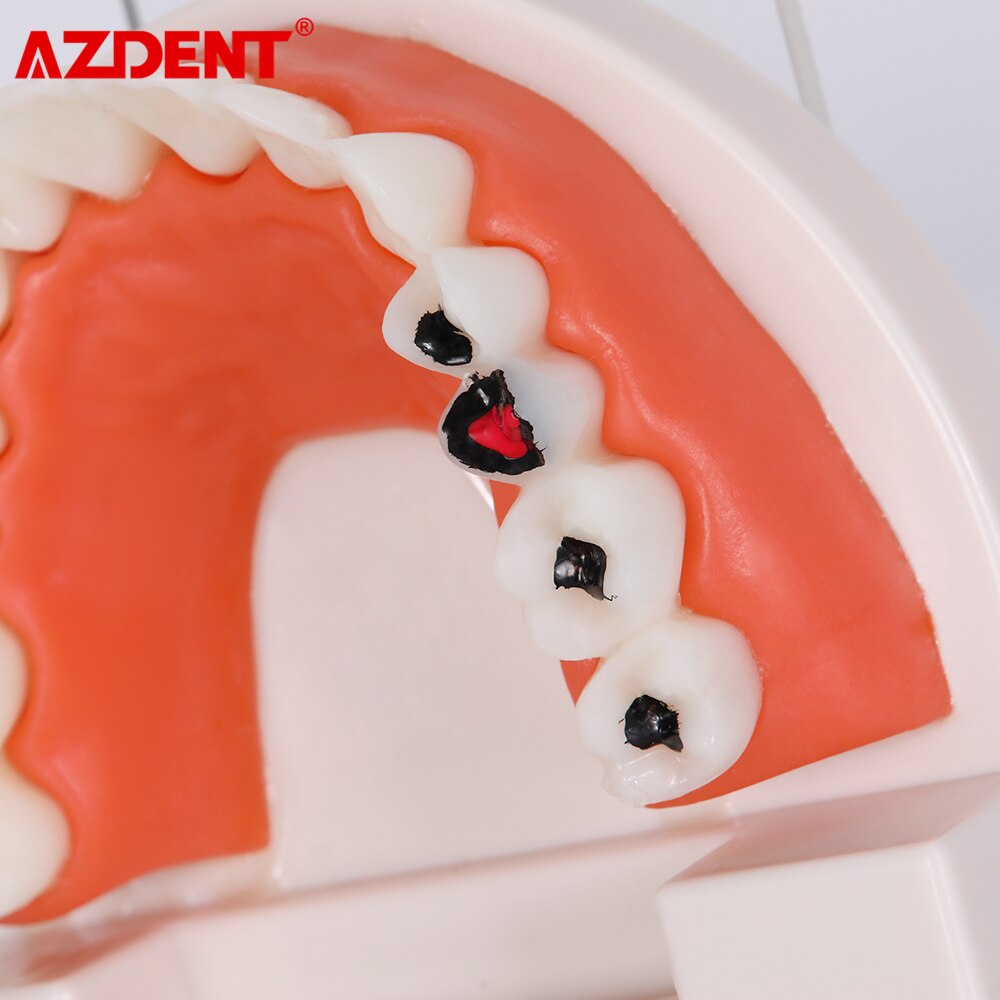 Dental Teeth Model Tooth Decay Model PVC School Teaching Equipment