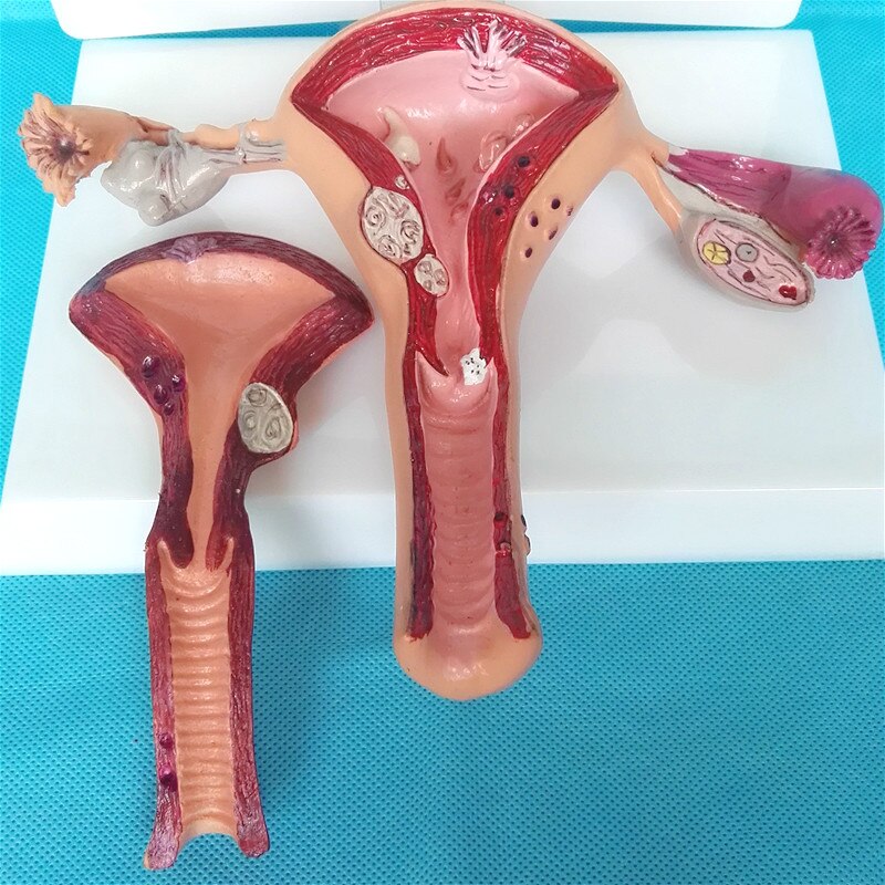 Female pathological uterus model Advanced simulation pathological uterus model of structure anatomy of gynecology and obstetrics