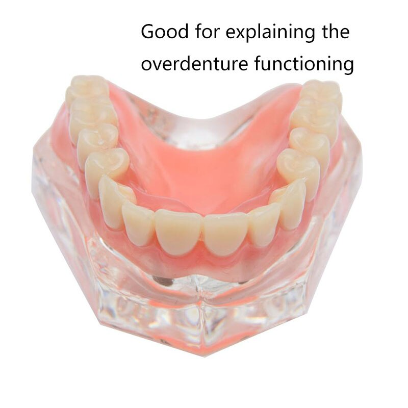Dental Implant Teeth Teaching Model Overdenture Restoration Clear Removable Interior Maxillary Mandibular Tooth Demonstration