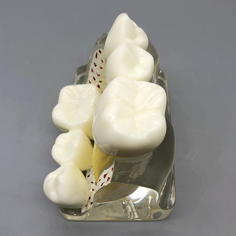 4 Times Dental Implant Analysis Crown Bridge Demonstration M2017T Dental Teeth Model Dentist Patience Model