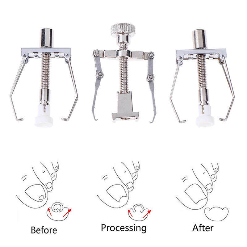 Ingrown Toenail Correction Tool Nail Corrector Tool Kit Toe Paronychia Nail Brace Pedicure Care Tool