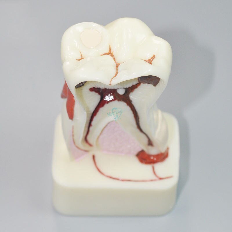 1 pièces dentiste étude dentaire enseignement modèle de dent 4 modèles de maladie des dents