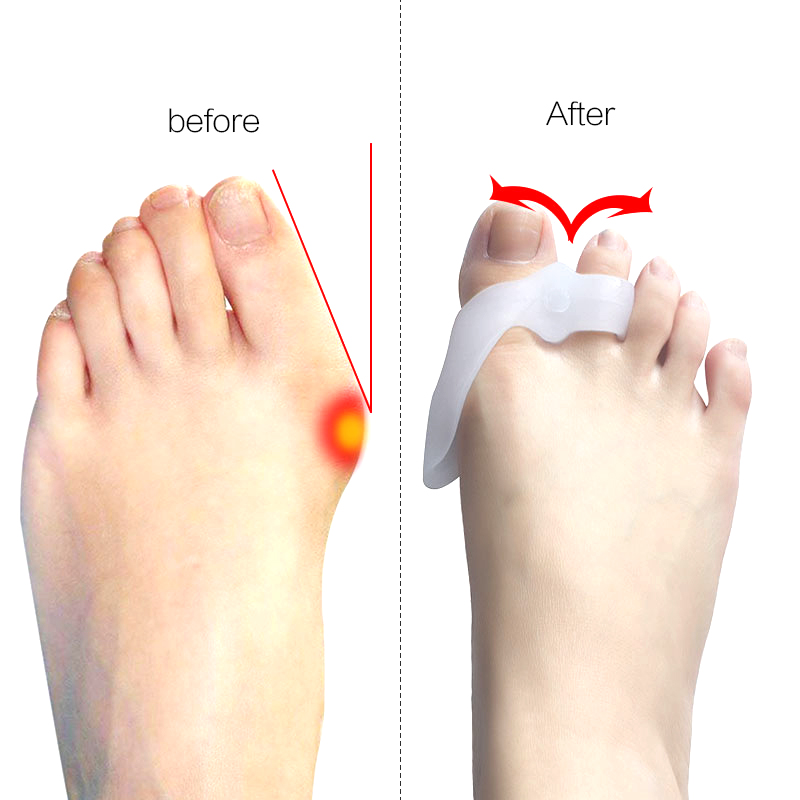 2 paar Gel Fußpflege Werkzeug Ballen Korrektor Knochen groß Zehe Schutz Hallux Valgus Haarglätter Kappe Separatoren Pedikübetreffend Korrektor