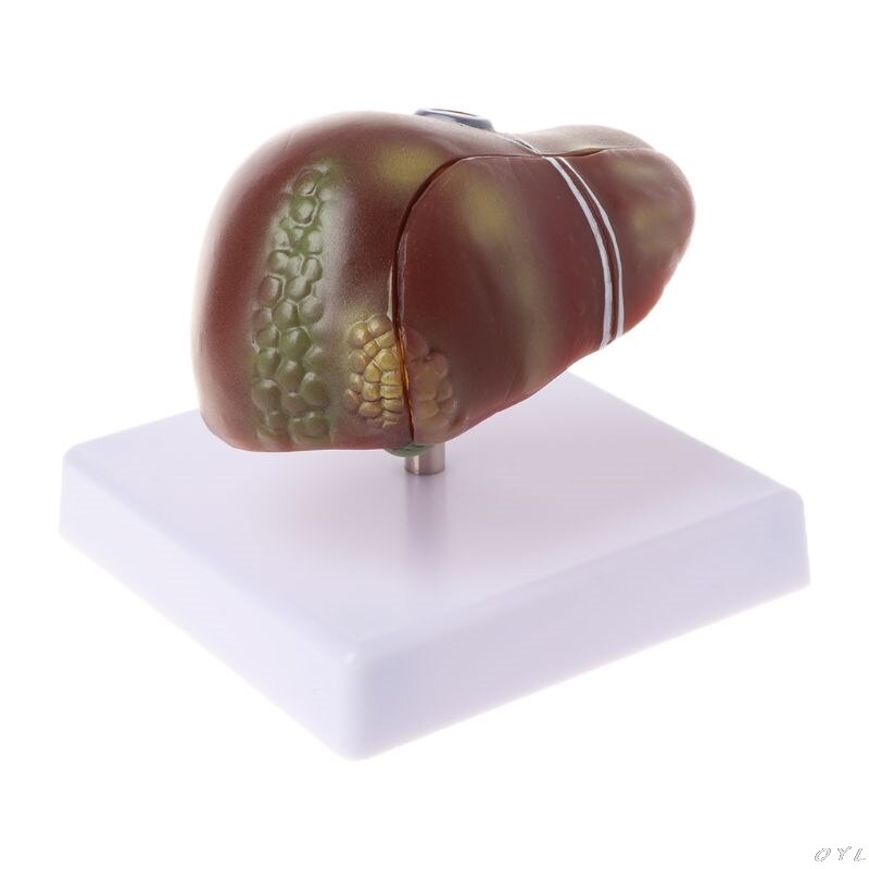 Modelo anatómico patológico del hígado humano, herramienta de exhibición para enseñanza escolar de anatomía, equipo de laboratorio L29K