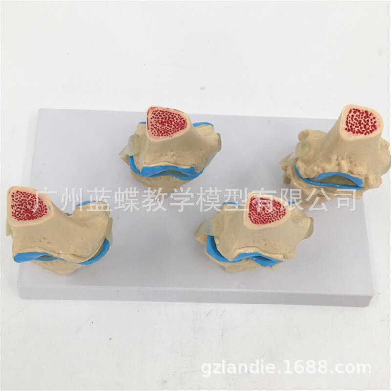 4 pcs Human pathological knee joint model Degenerative arthritis of knee joint