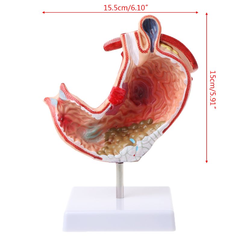 Human Anatomical Anatomy Stomach Model Gastric Pathology Gastritis Ulcer Teaching Learning Tool U4LD
