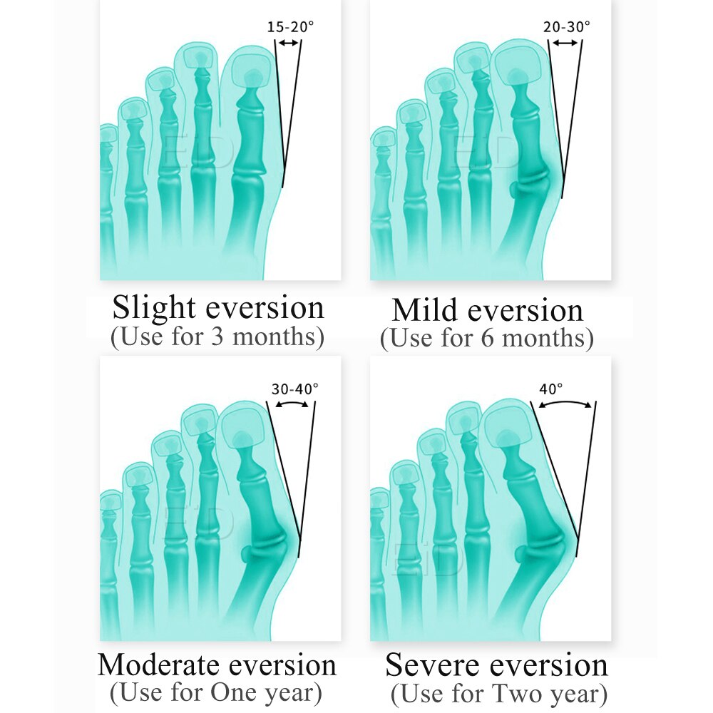Eid hallux valgus ortose silikone tåseparator knystpuder korrektionsspreder fodbeskytter finger smertelindrende indlæg