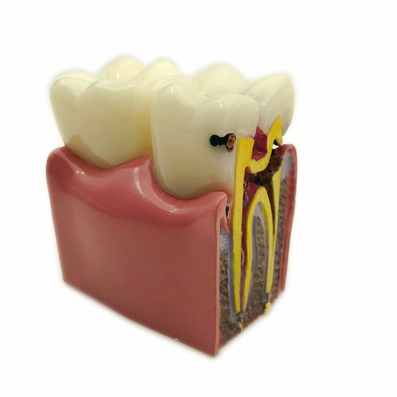 1pc Dental Anatomy Education Teeth Model 6 Times Caries Comparation Study Models For Dentist Studying and Researching