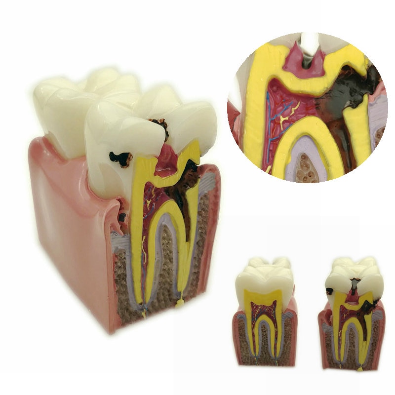 1pc Dental Anatomy Education Teeth Model 6 Times Caries Comparation Study Models For Dentist Studying and Researching