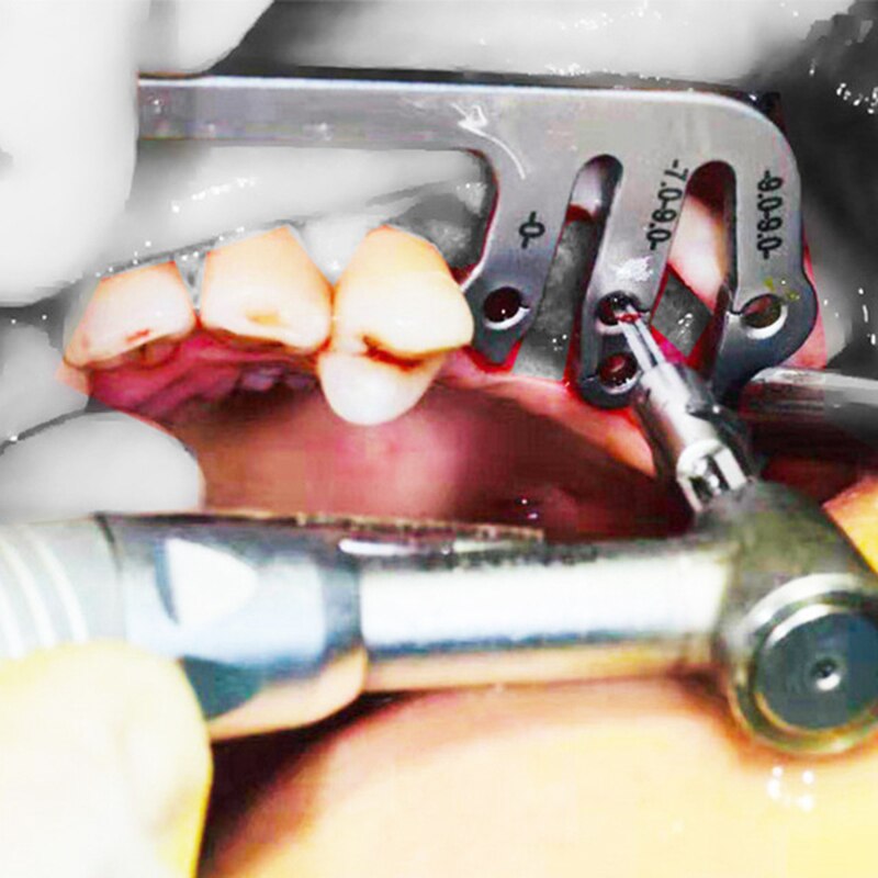 Dental Implant Guide Set Oral Planting Locator Positioning Guide Drilling Positioning Ruler Angle Ruler Implant Tools Dentist