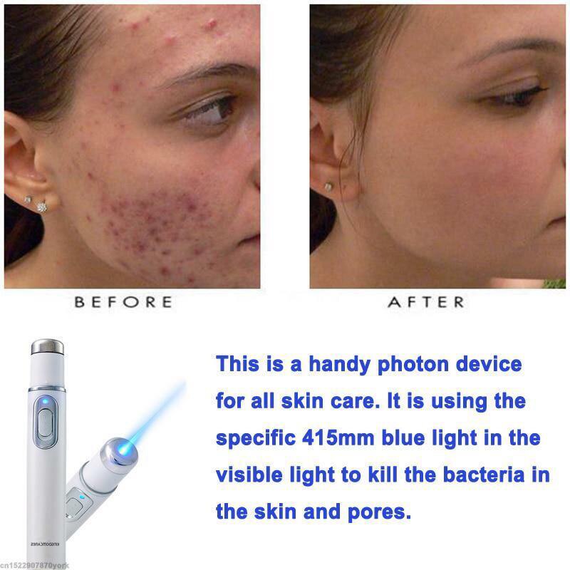 Stylo Portable anti-acné à lumière bleue, outil de soins de la peau, suppression des rides, SHRA889