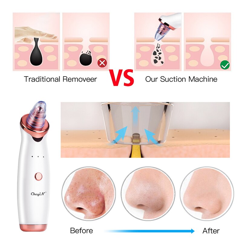 Ckeyin Professionele Skin Peeling Mee-eter Verwijderen Scrubber Schop Exfoliërende + Oplaadbare Comedondrukker Gezicht Porie Schoner