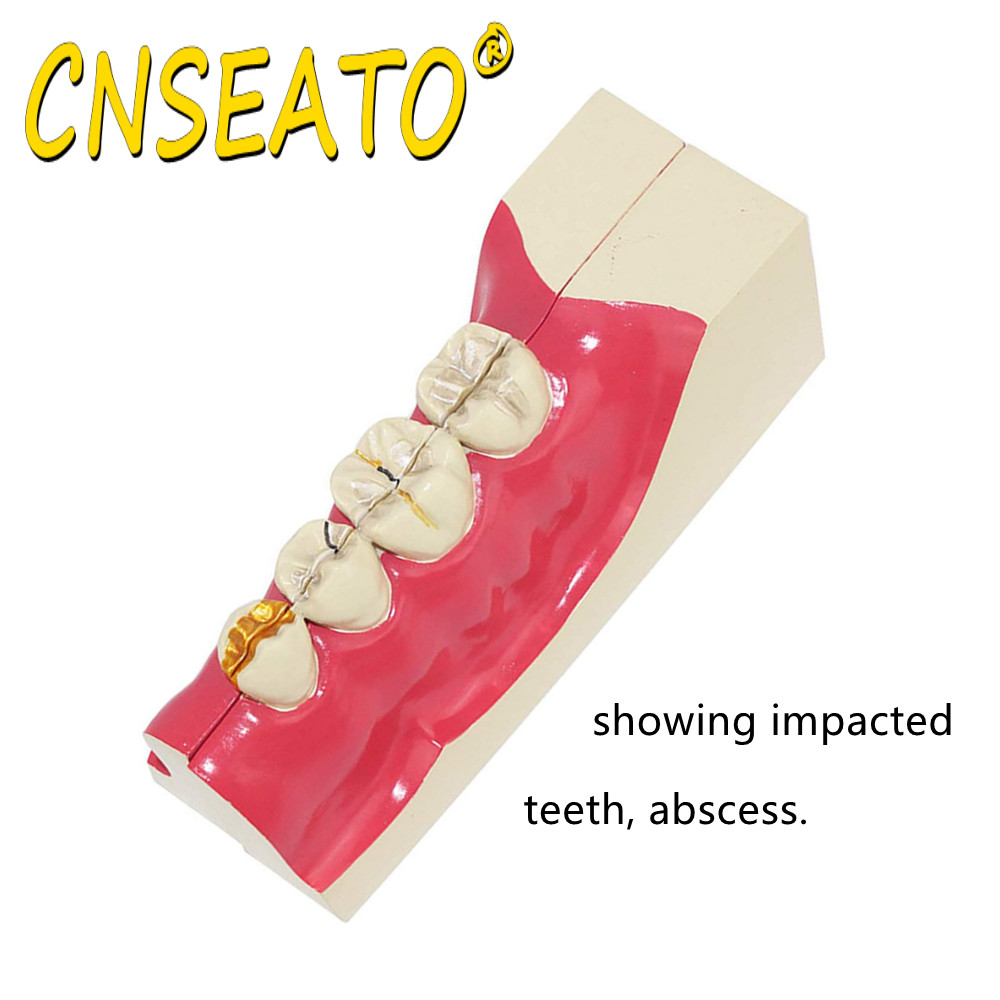 CNSEATO Dental Study Model Right Lower Tooth Decom... – Grandado