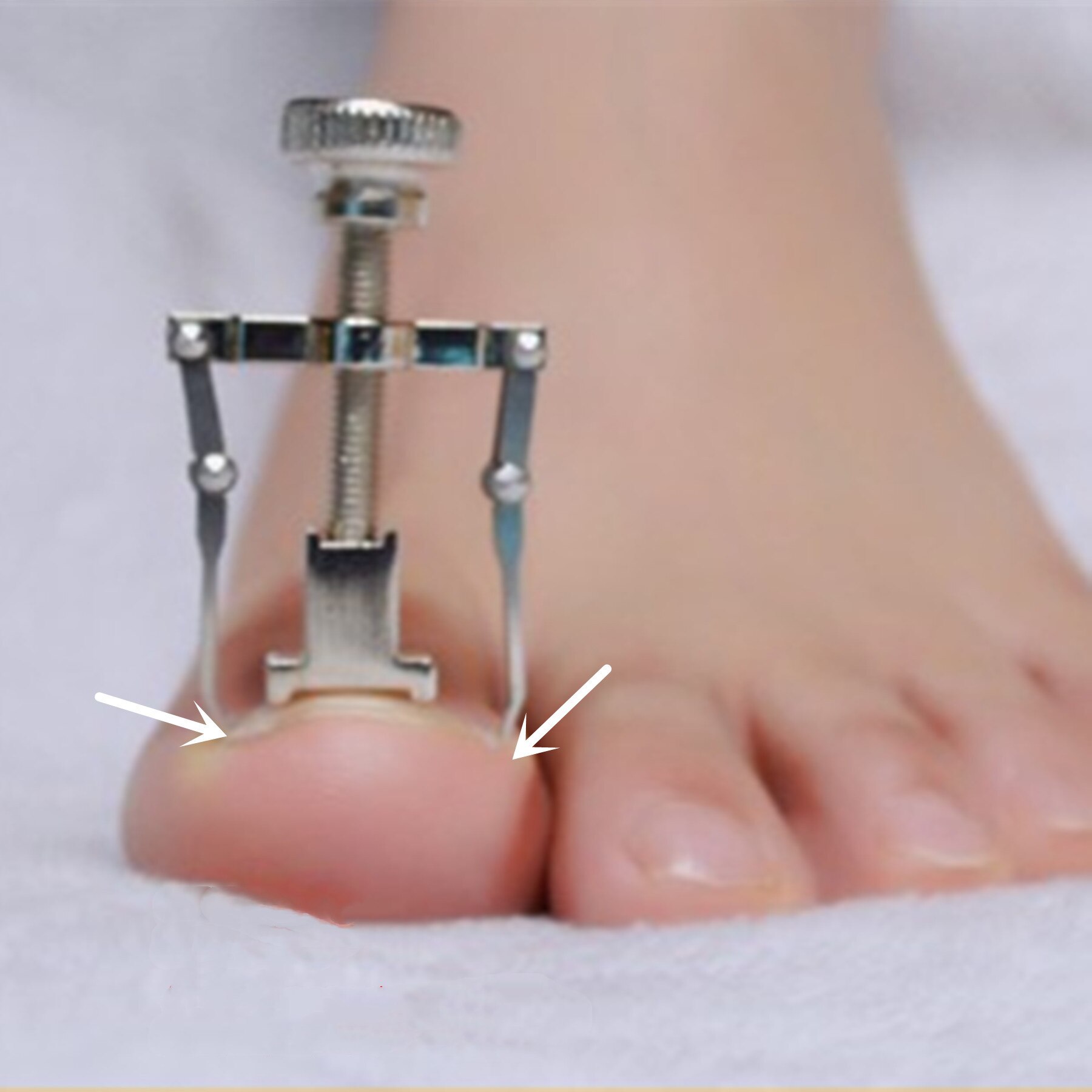 Sølv indgroet tå negle fixer pedicure genoprette integreret tånegl korrektion løfter værktøjssæt  lj18
