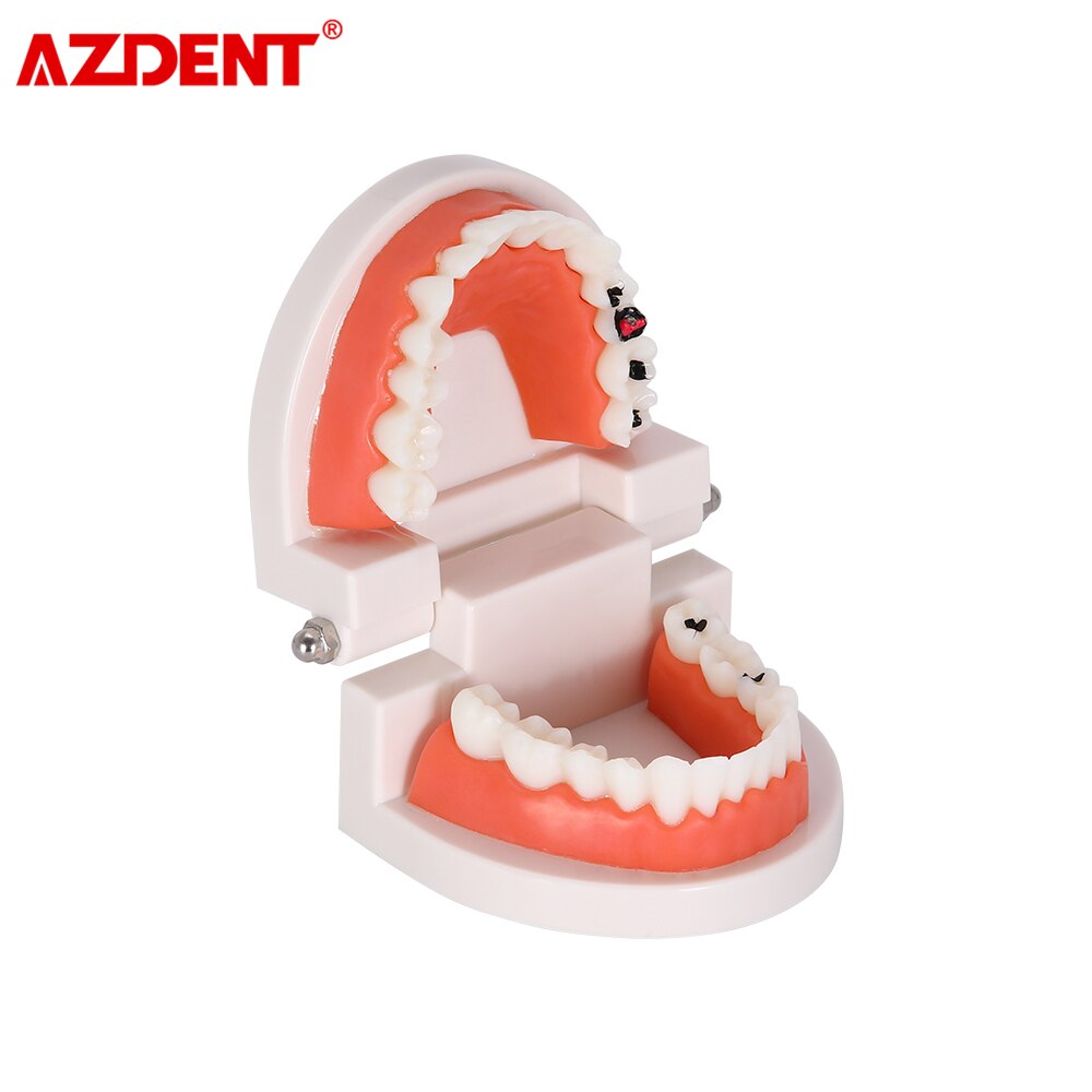 Dental Teeth Model Tooth Decay Model PVC School Teaching Equipment
