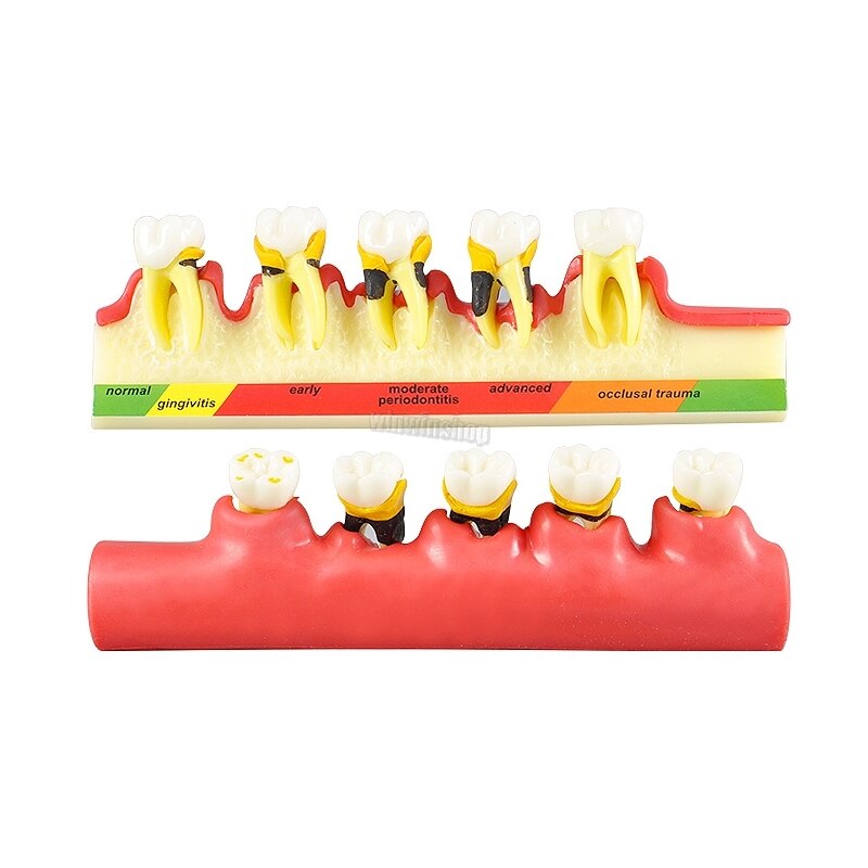 Dental Periodontal Disease Classification Model Demonstration Teach Study Decayed tooth Show Periodontal Disease Progress Model