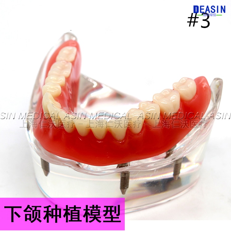 1 pc x Resin Coverage dental implant model dentures Removable teeth model for dentist study Deasin