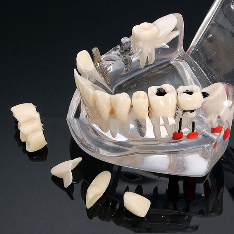 Tandheelkundige Restauratie Tanden Model Transparante Implant Disedental Implant Ziekte Tanden Model Met Restauratie Brug Tand Tandarts