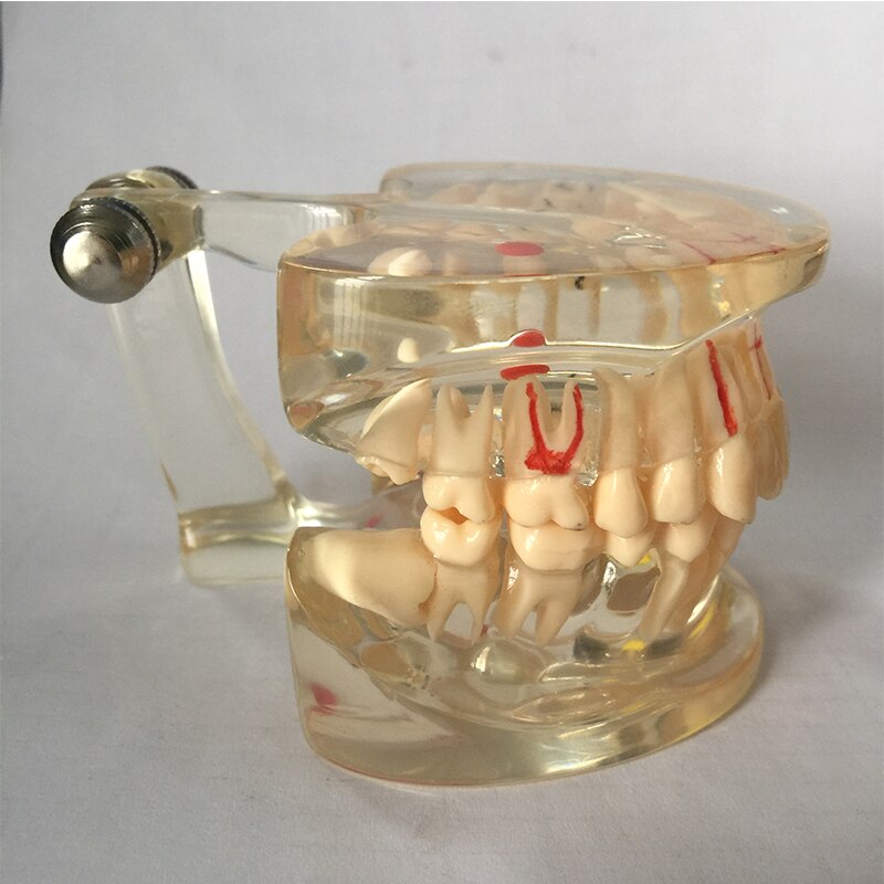 Dental Model M4017 - Adult Pathological Periodontal Disease Study Teaching Teeth