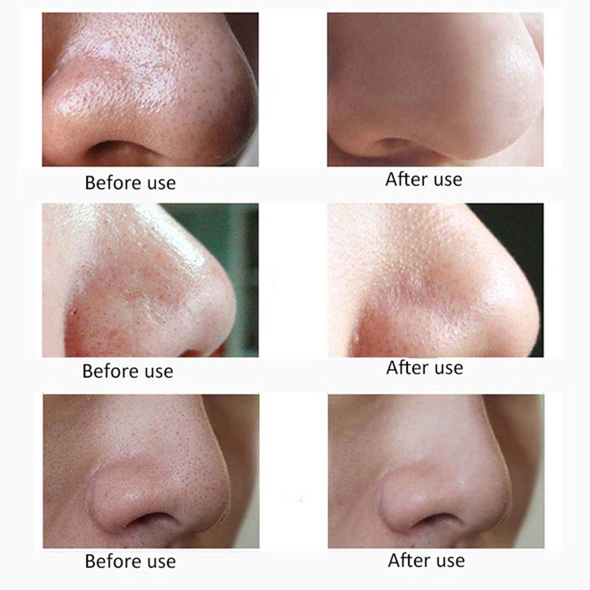 Face Acne Black Dot Pimple Blackhead Remover Electric Microcrystalline Blackhead Vacuum Cleaner Pore Blackhead Skin Care Machine