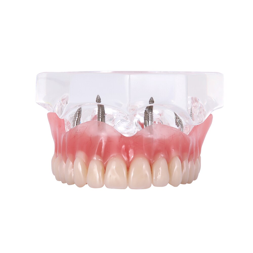 Dental Implant Teeth Model Removable Interior Mandibular Demo Overdenture With Implants upper/Lower for Tooth Teaching Study: Upper - 4 Implants