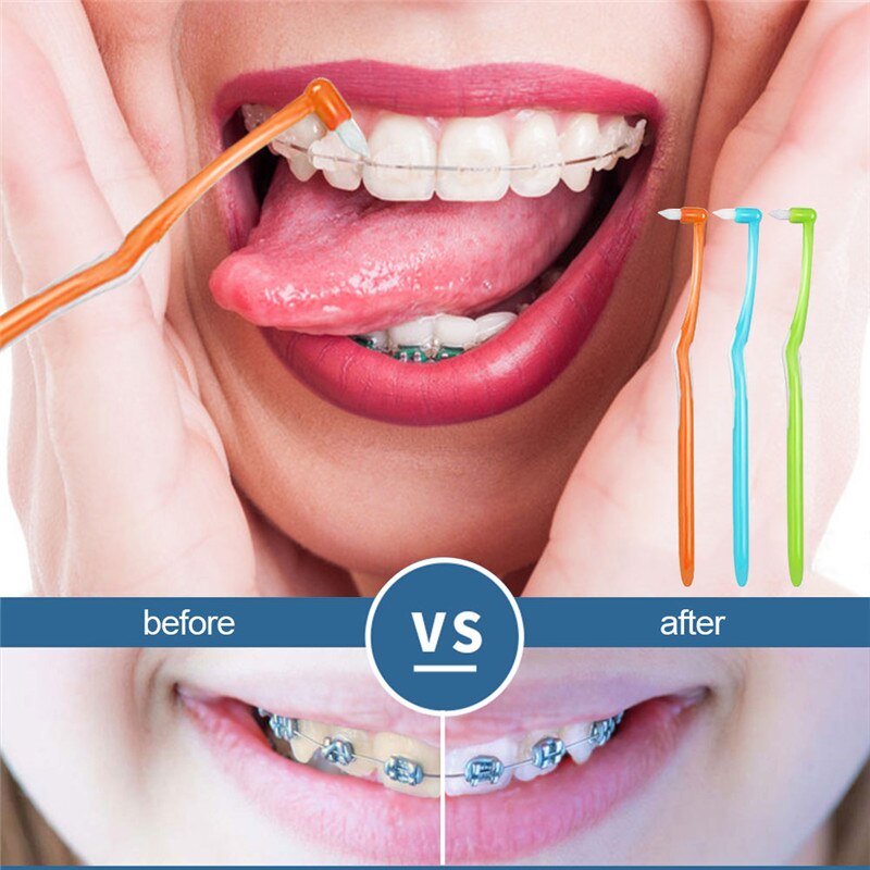 Y-kelin U-shaped small head Orthodontic Toothbrush Soft Bristle orthodontia teeth brush brace toothbrush