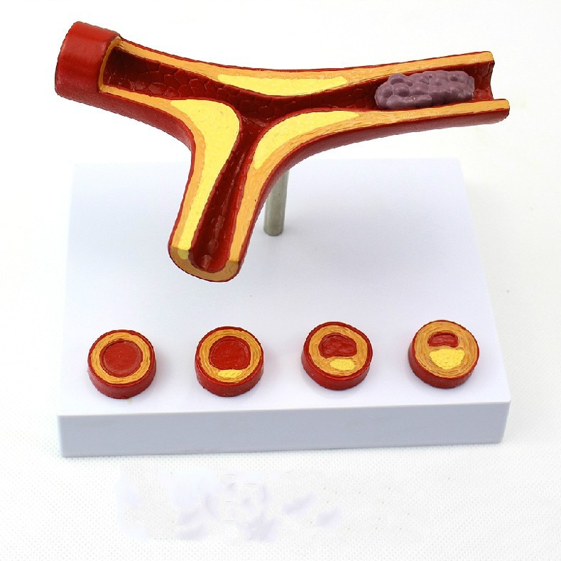 10X Enlarge Human Arterial Coronary Arteriosclerosis Atherosclerosis Coronary Model Cross Section Heart Disease Thrombus Model