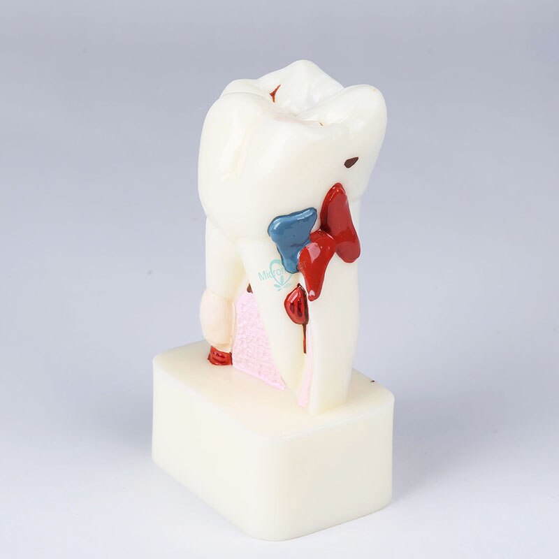 1 pièces dentiste étude dentaire enseignement modèle de dent 4 modèles de maladie des dents