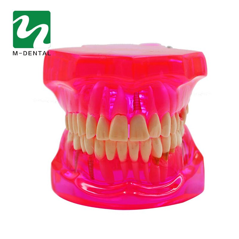 Modelo de dientes de estudio Dental desmontable para adultos, modelo de dientes de enseñanza patológica, rojo transparente, 1 unidad