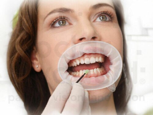 Optragato Dental 3D, retardador de mejillas, abridor de boca, tamaño pequeño, 6,0 cm, 100% Ivoclar Vivadent