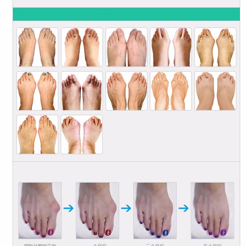 55Pairs Toe Separators Stretchers Straighteners Alignment Bunion Gel 2 Holes Overlapping Orthotics Hammer Toes Feet Care