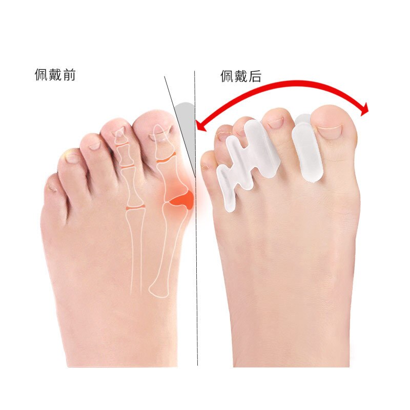 Hallux valgus toe separator Big toe overlapped toe toe correction toe Toe orthosis