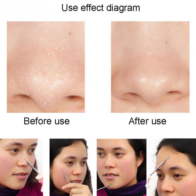 Pimple Pin 12.5cm Double head Stainless Steel Blackhead Remover Cleanser Face Skin Care Tool Pimple Pin Facial Blackhead Remover