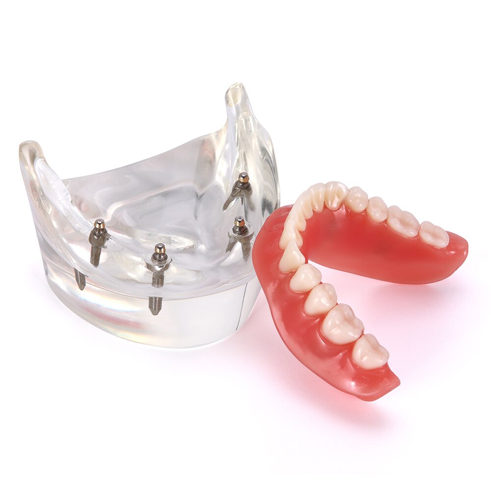 Dental Implant Teeth Model Removable Interior Mandibular Demo Overdenture With Implants upper/Lower for Tooth Teaching Study: Lower - 4 Implants