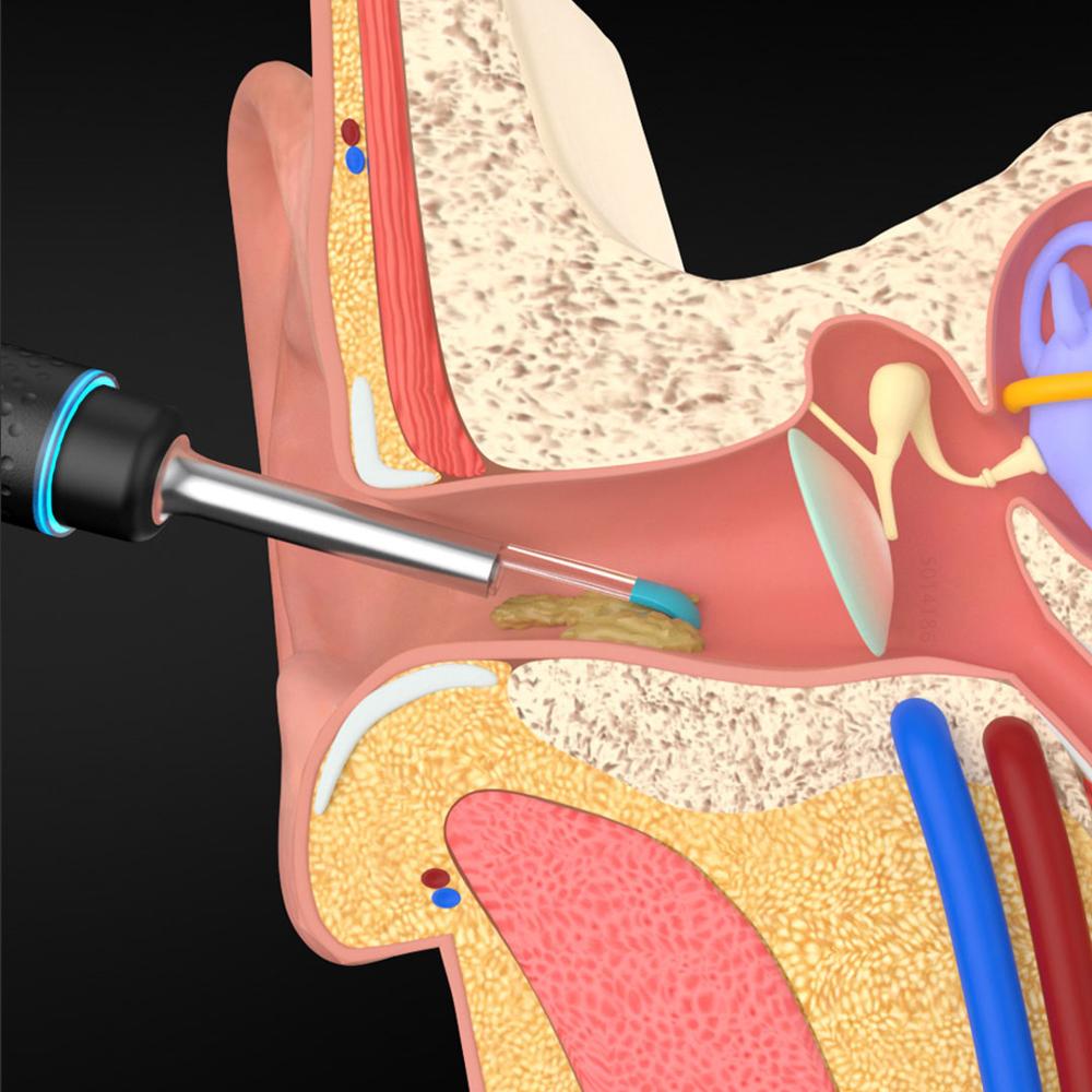 Xiaomi-limpiador de orejas Bebird M9 Pro, endoscopio, Mini cámara de 300W, otoscopio, boroscopio, juego de herramientas
