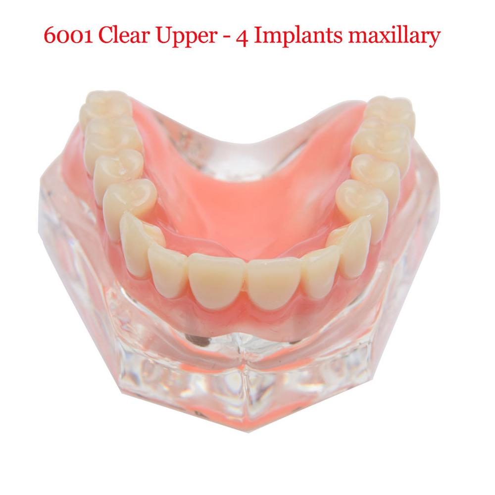 Dental Implant Teeth Teaching Model Overdenture Restoration Clear Removable Interior Maxillary Mandibular Tooth Demonstration: 6001 Upper 4