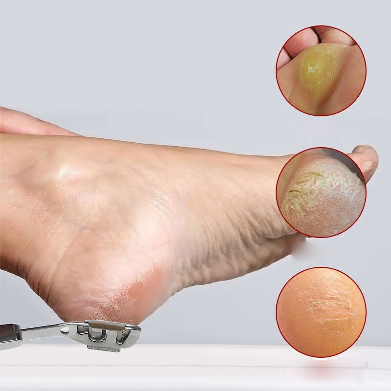 Callos, para pies maquinilla de afeitar, removedor de piel de tacón duro, herramienta de afeitar para pedicura, maquinilla de afeitar con mango de acero inoxidable, 10 cuchillas, herramienta de cuidado de pies