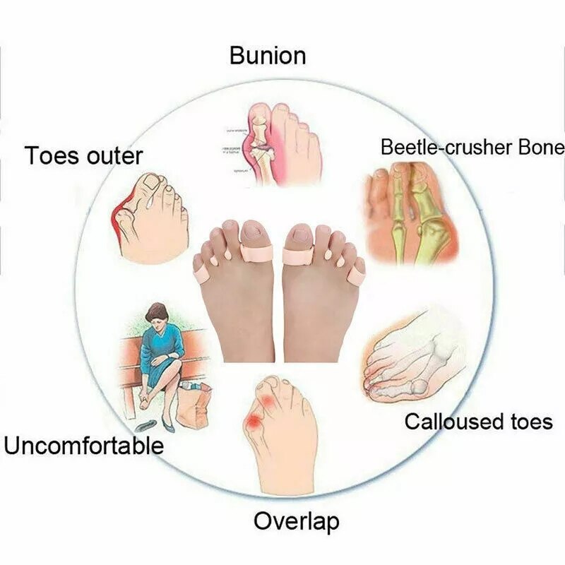 Corretor de joanete ortopédico, separador de dedos dos pés, alisador de hálux valgus, protetor de dedos espaçadores para cuidados com os pés, 6 peças = 3 pares