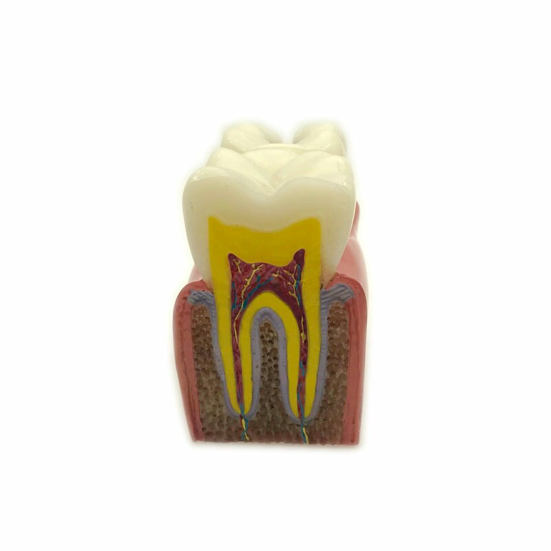 1pc Dental Anatomy Education Teeth Model 6 Times Caries Comparation Study Models For Dentist Studying and Researching