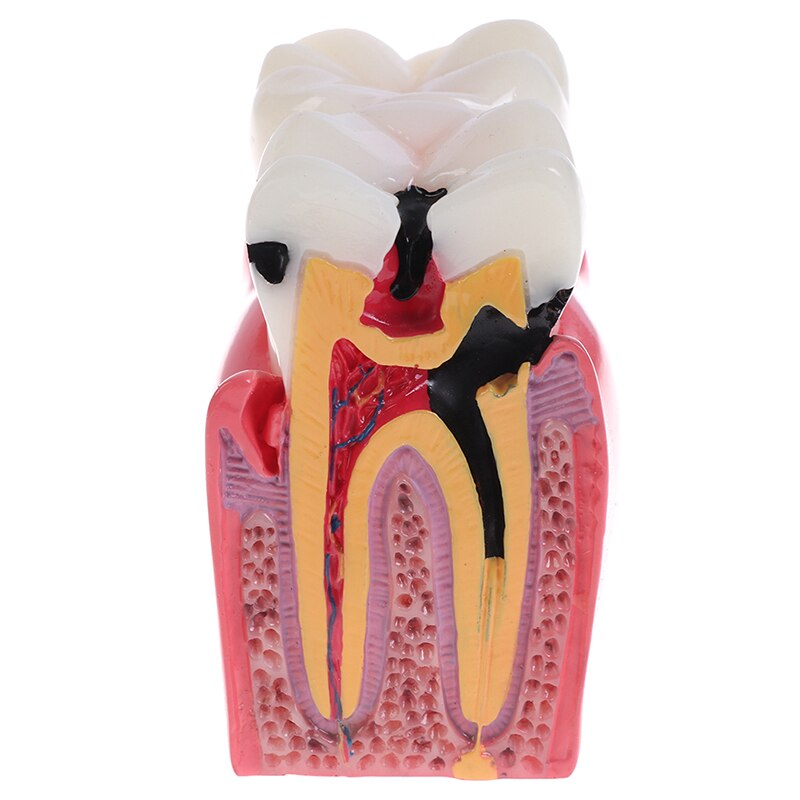 Dental Teeth Model 6 Times Caries Comparation Study Denture Tooth Models