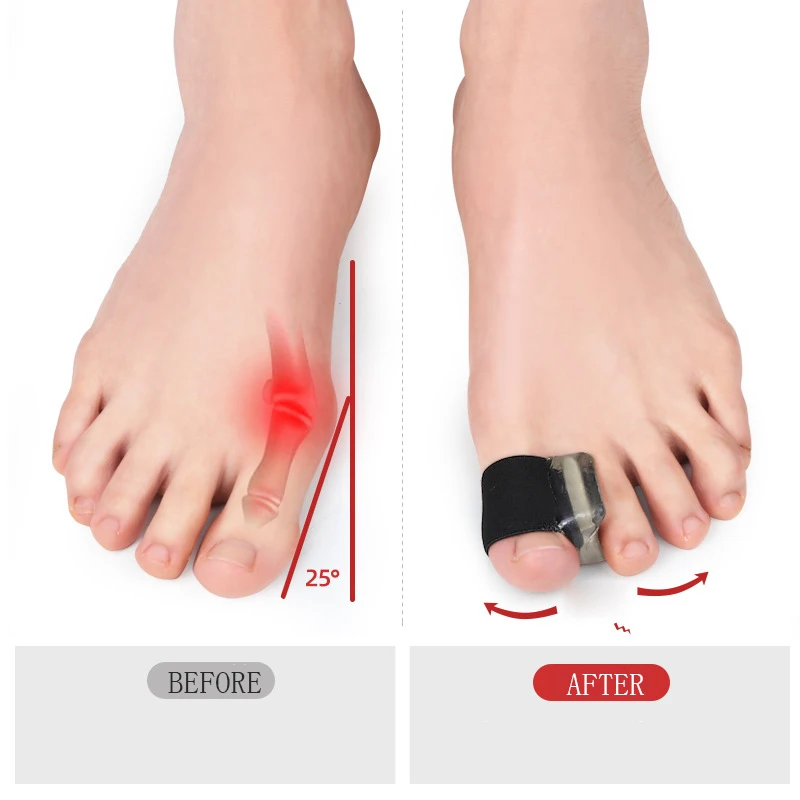 1 Stücke Spannungsgurt Hallux Valgus Schutz Daumen Zehenspreizer Schmerzlinderung Zehen Finger Separator Zehenschiene Ballen Erzähler Werkzeug