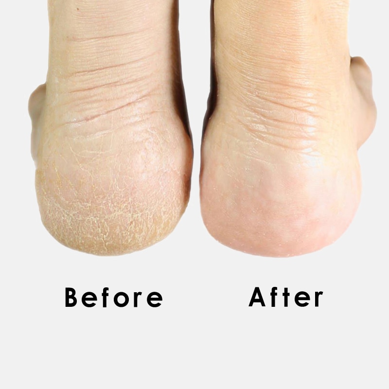 Microplane râpe pour pieds talon râpe fichier pied pédicure callosités dissolvant dur peau morte épurateur manucure outils noir pied gommage
