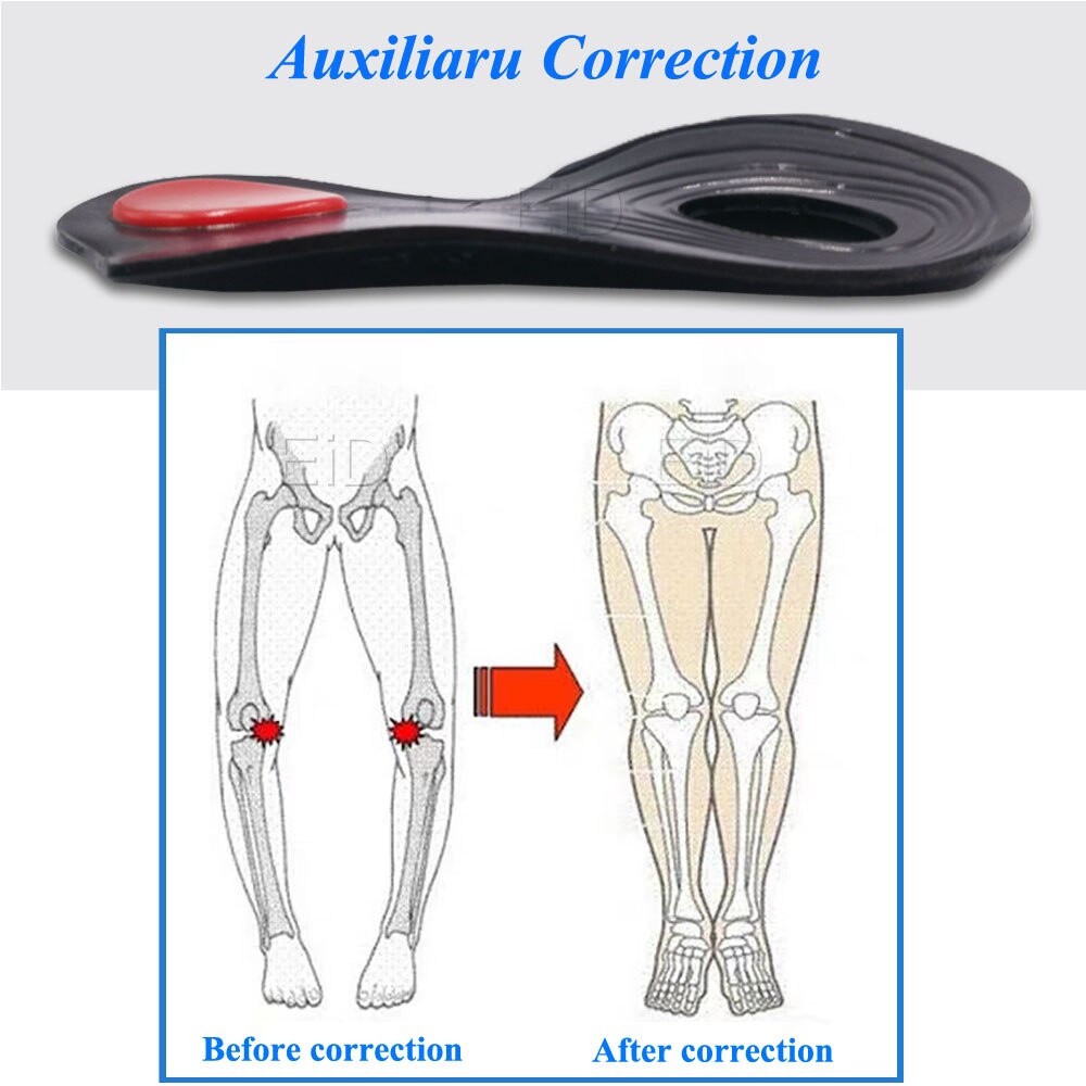 OX Leg Orthotics Cubitus Varus half flat foot Insole Orthopedic Insoles for Shoes insert Arch Support pad for plantar fasciitis