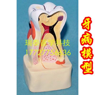 Menselijk Model 6*5*11Cm Cariës Model Pathologische Orale Modellen Tandbederf Structuur Van Dentine Pathologie