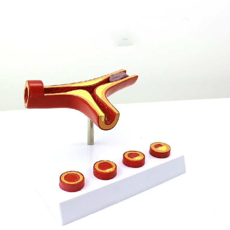 10X Enlarge Human Arterial Coronary Arteriosclerosis Atherosclerosis Coronary Model Cross Section Heart Disease Thrombus Model