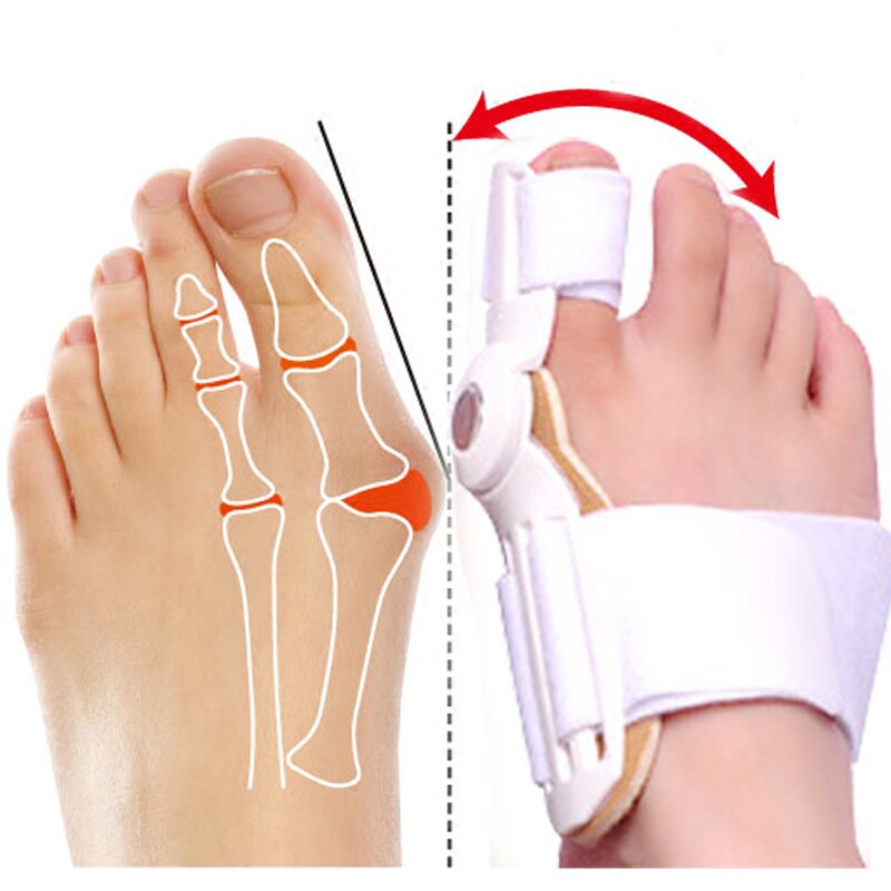 20 Pcs Hallux Valgus Spalk Bunion Hamer Teen Straightener Hallux Valgus Corrector Pijn Bunion Corrector Teen Separator