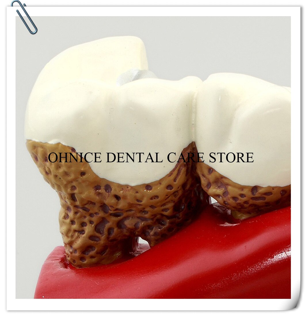 Dental Pathologies Model M4029 showing caries and apical lesion conditions/Dental Study tooth model Doctor-patient communication